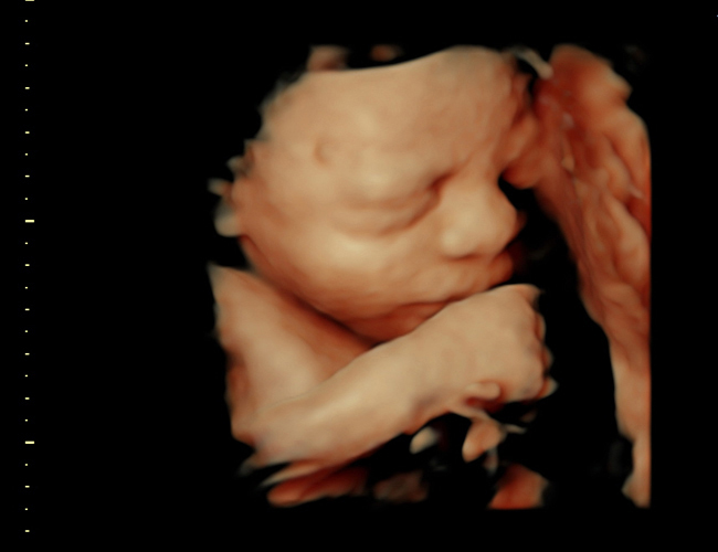 3D ultrasound image at 31 weeks